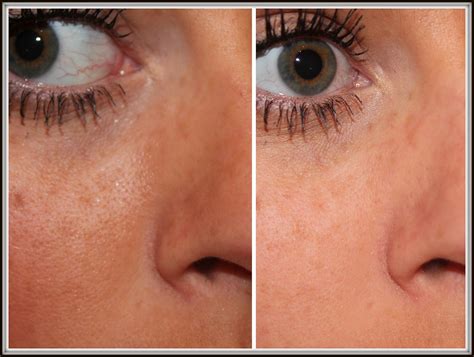 pore minimizer before and after.